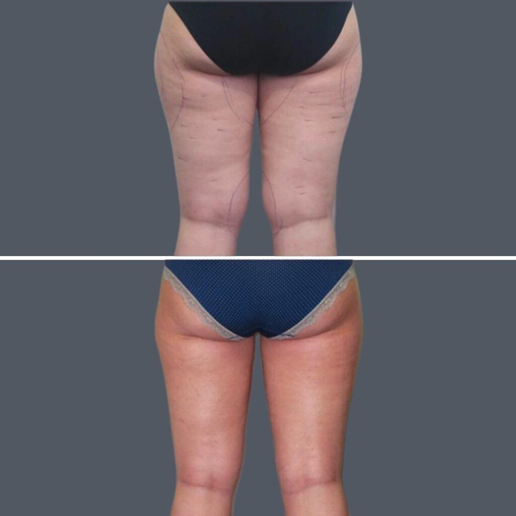 Cellulite Reduction Female Pre2024 026 Before And After