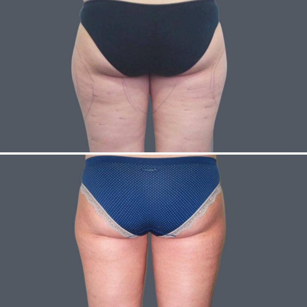 Cellulite Reduction Female Pre2024 027 Before And After