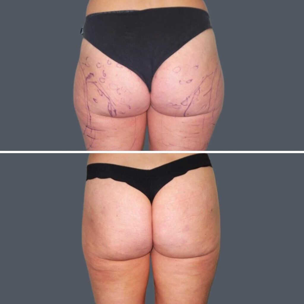 Cellulite Reduction Female Pre2024 028 Before And After