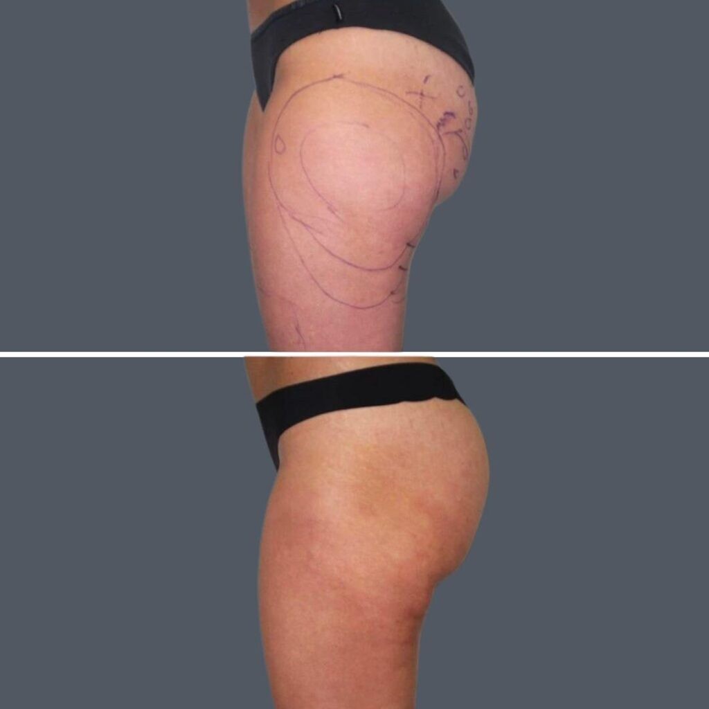 Cellulite Reduction Female Pre2024 029 Before And After