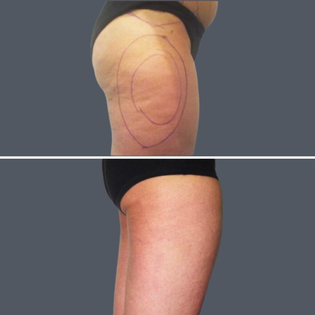 Cellulite Reduction Female Pre2024 030 Before And After