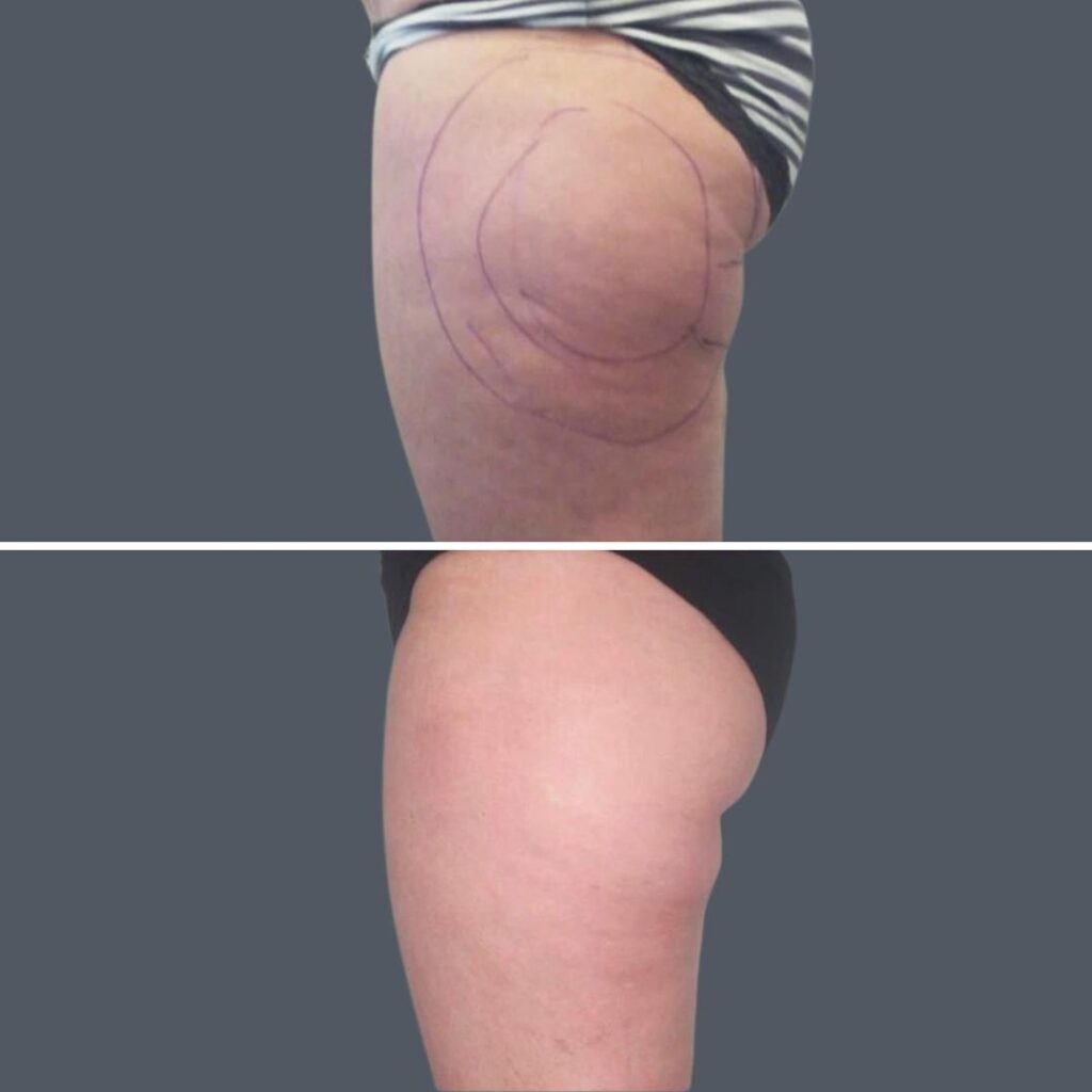 Cellulite Reduction Female Pre2024 031 Before And After