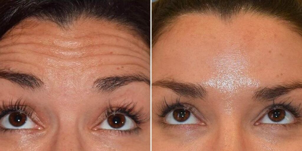 Face Anti Wrinkle Female Pre2024 001 Before And After