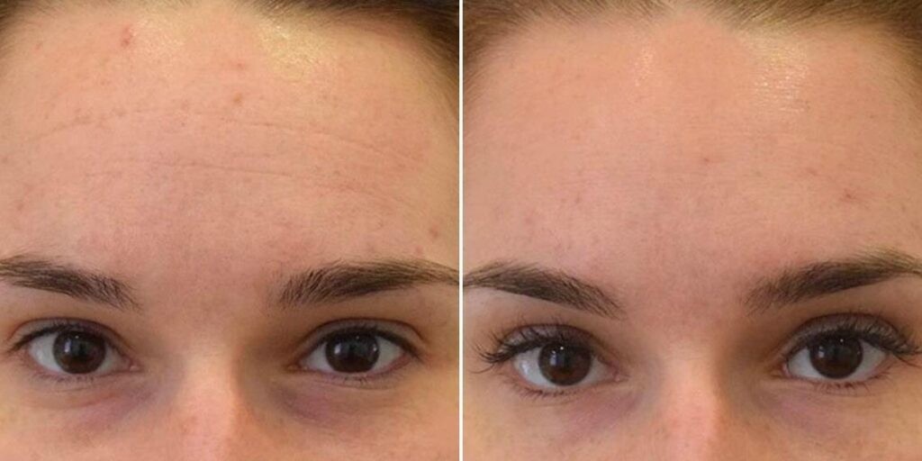 Face Anti Wrinkle Female Pre2024 002 Before And After