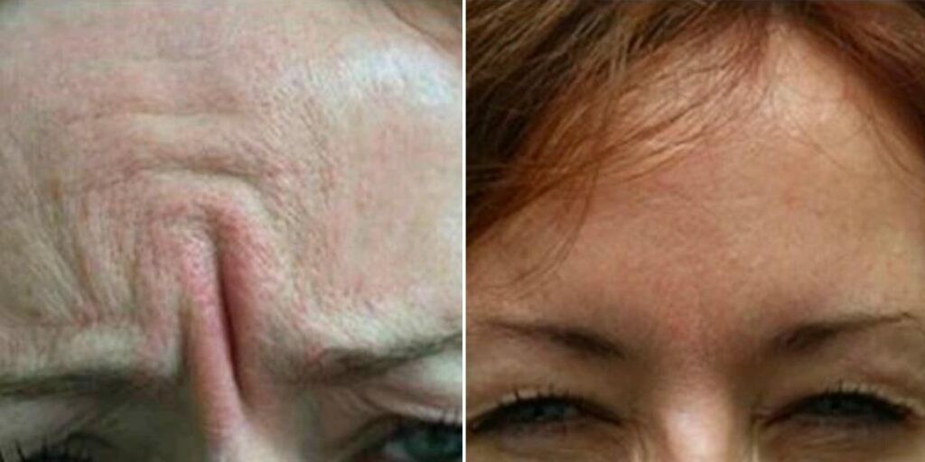 Face Anti Wrinkle Female Pre2024 003 Before And After