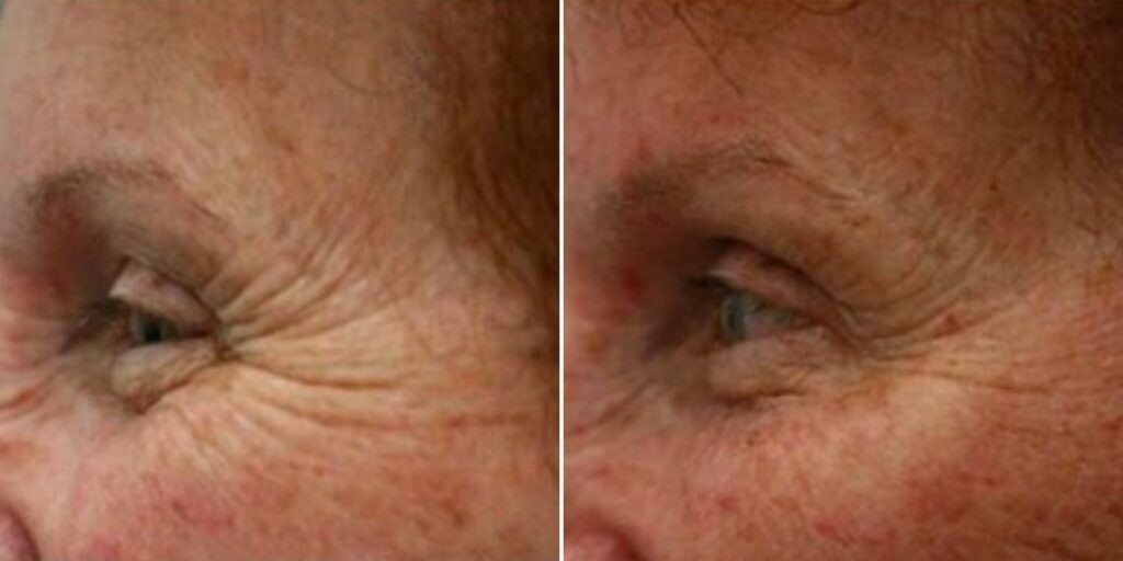 Face Anti Wrinkle Female Pre2024 004 Before And After