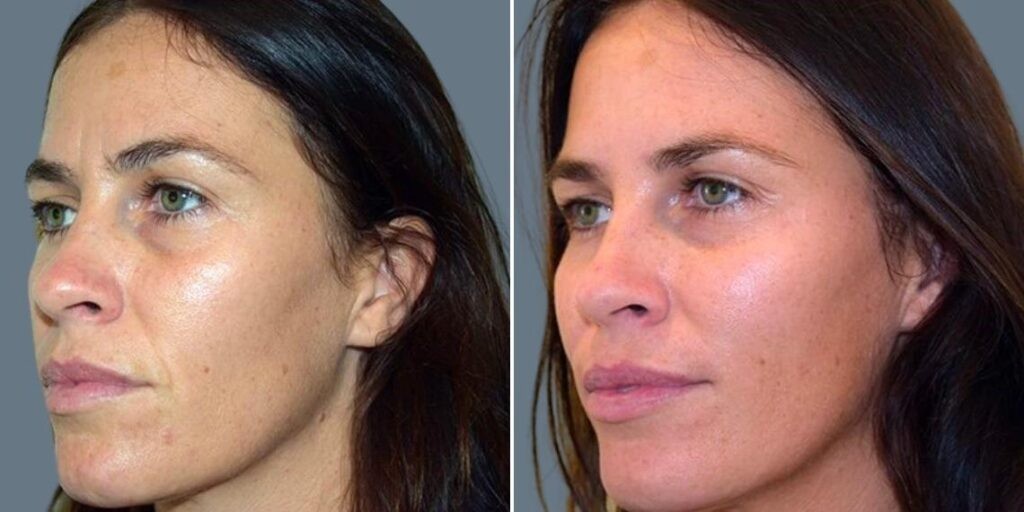 Face Anti Wrinkle Female Pre2024 005 Before And After