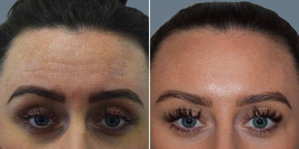 Face Anti Wrinkle Female Pre2024 006 Before And After