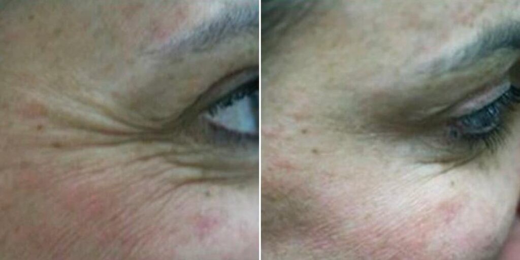 Face Anti Wrinkle Female Pre2024 007 Before And After