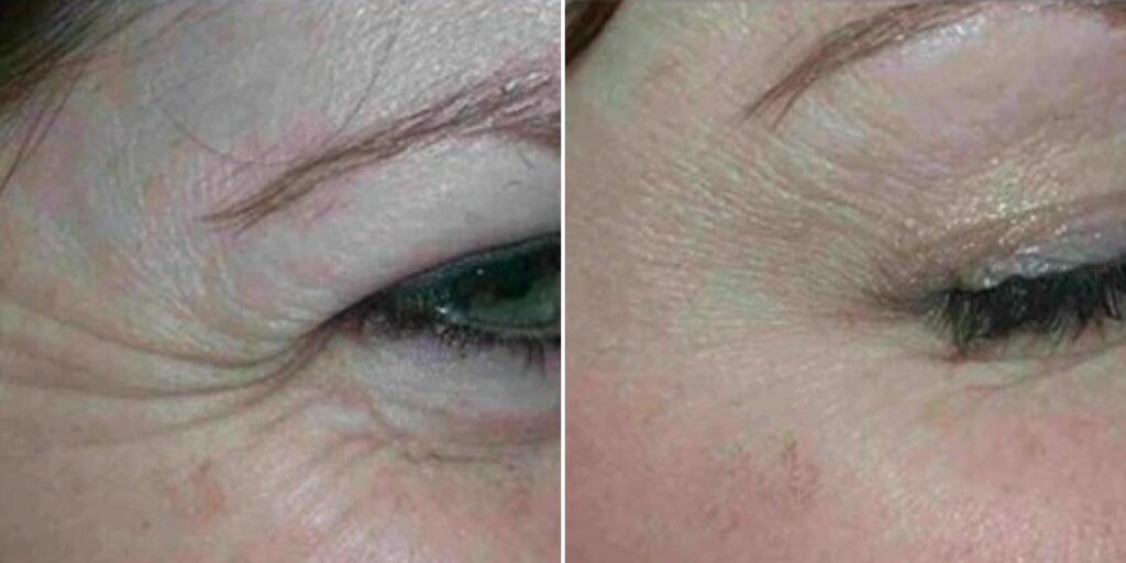 Face Anti Wrinkle Female Pre2024 008 Before And After