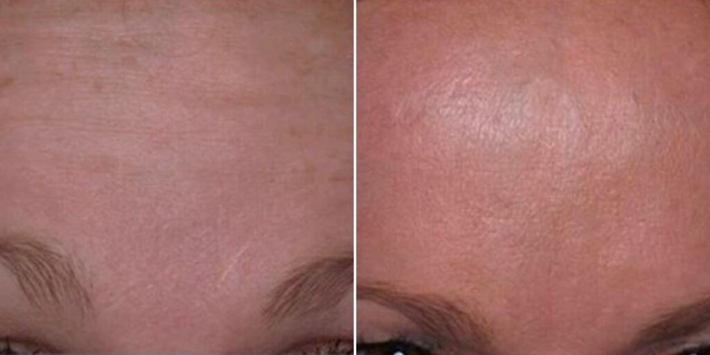 Face Anti Wrinkle Female Pre2024 009 Before And After