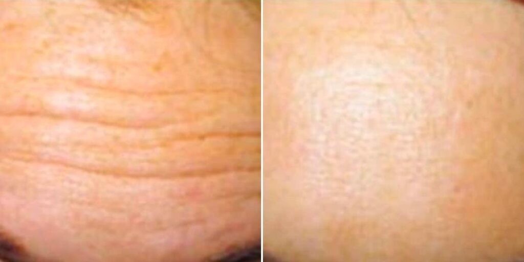 Face Anti Wrinkle Female Pre2024 010 Before And After