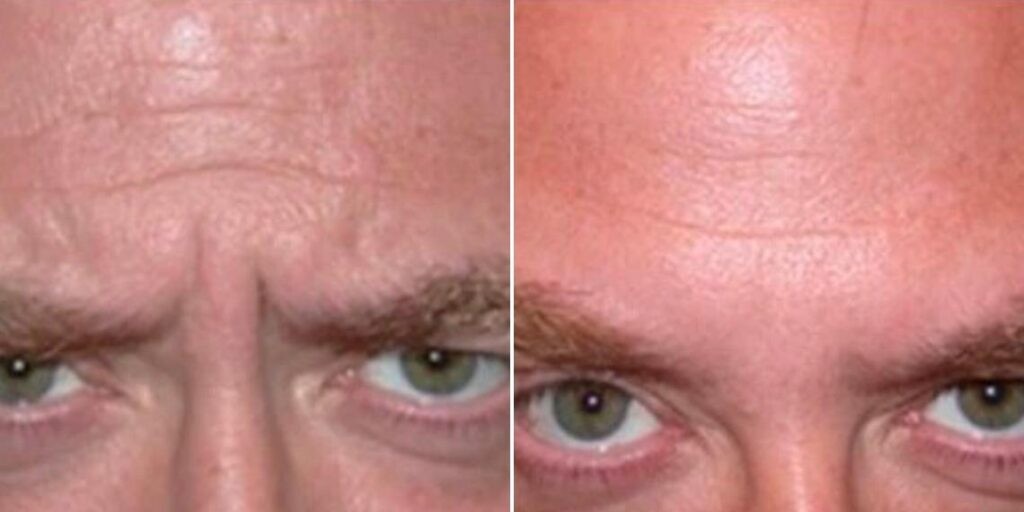 Face Anti Wrinkle Male Pre2024 011 Before And After