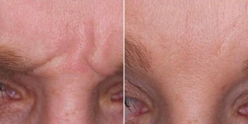 Face Anti Wrinkle Male Pre2024 012 Before And After