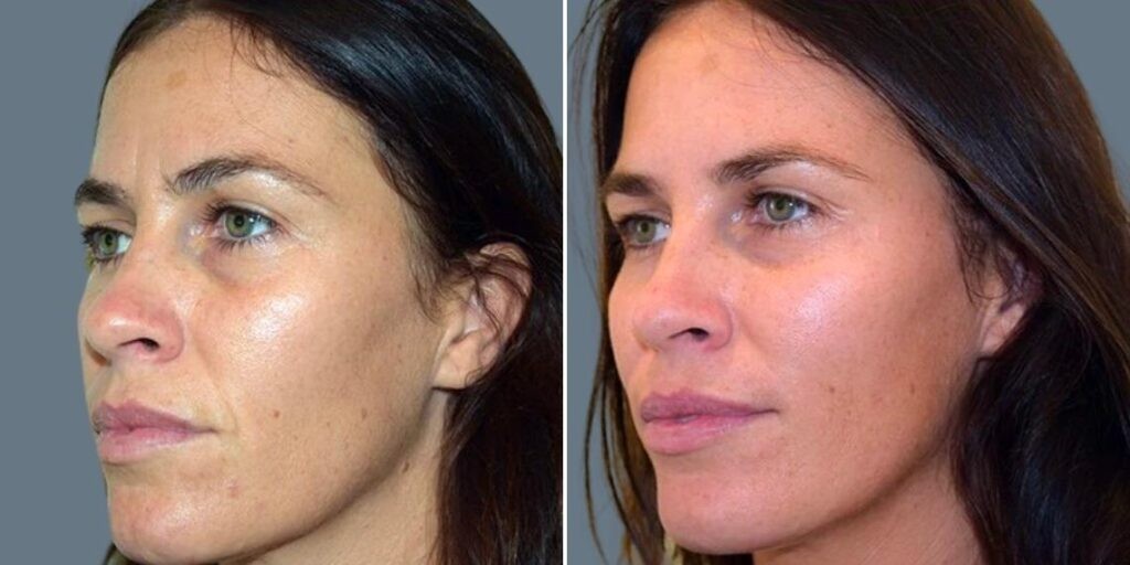 Face Cheek Enhancement Female Pre2024 001 Before And After