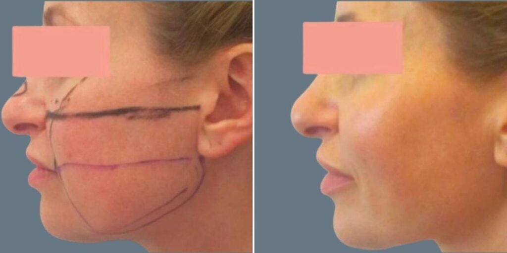 Face Cheek Enhancement Female Pre2024 003 Before And After
