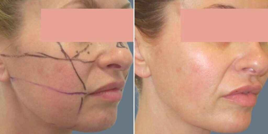 Face Cheek Enhancement Female Pre2024 004 Before And After