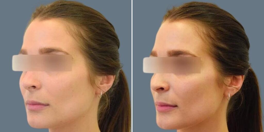 Face Cheek Enhancement Female Pre2024 005 Before And After