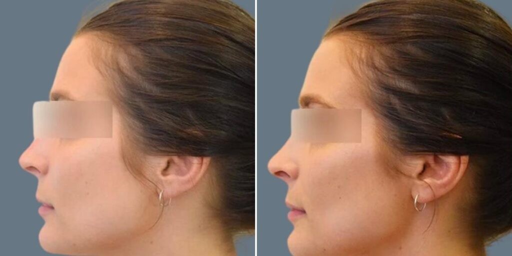 Face Cheek Enhancement Female Pre2024 006 Before And After