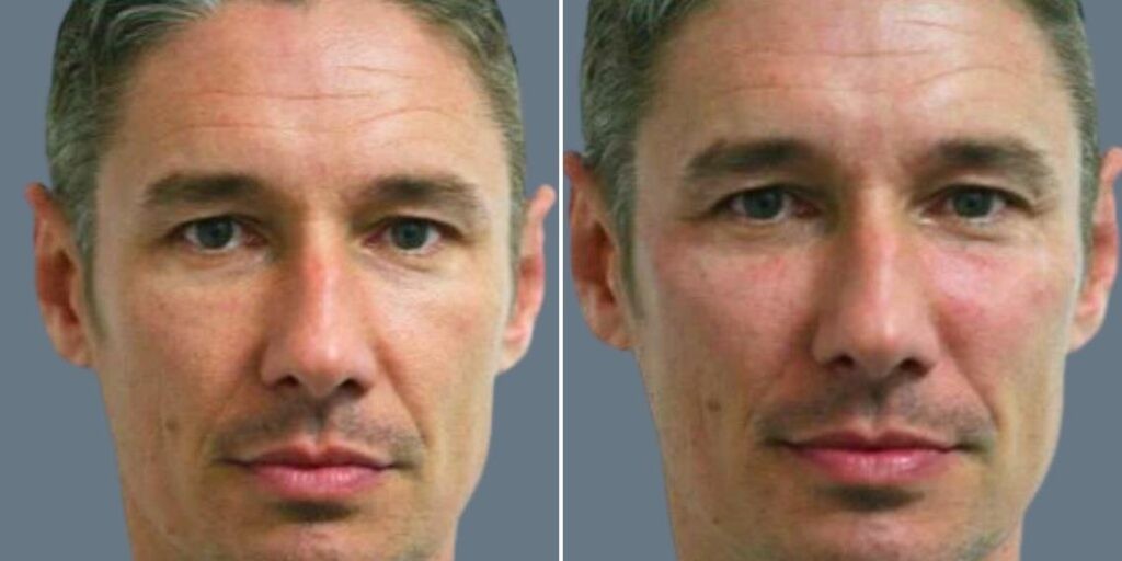 Face Cheek Enhancement Male Pre2024 007 Before And After
