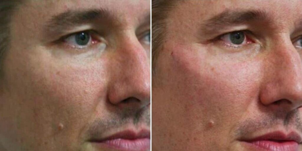 Face Cheek Enhancement Male Pre2024 008 Before And After