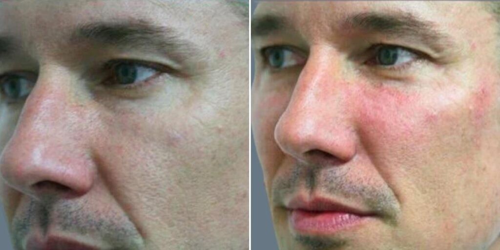 Face Cheek Enhancement Male Pre2024 009 Before And After