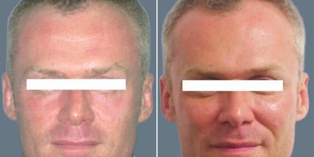 Face Cheek Enhancement Male Pre2024 012 Before And After