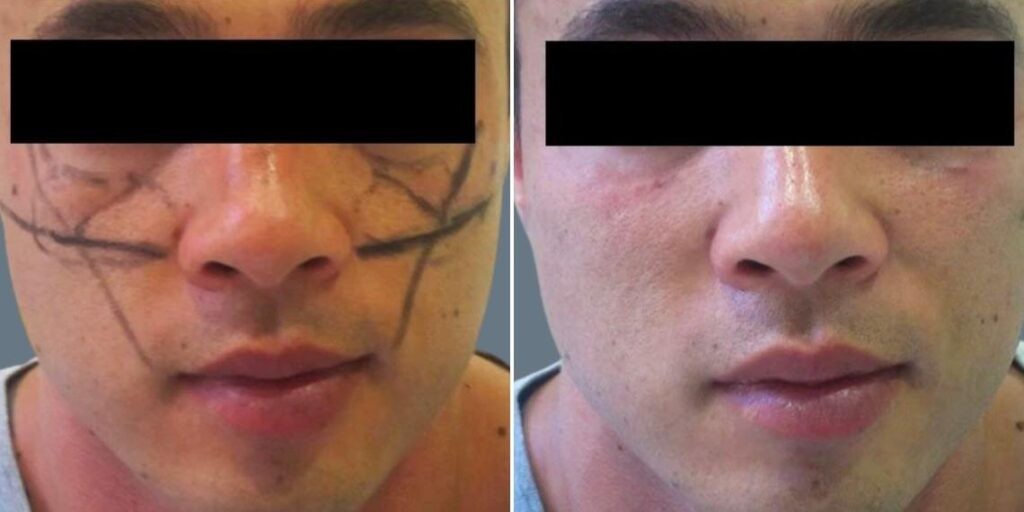 Face Cheek Enhancement Male Pre2024 013 Before And After