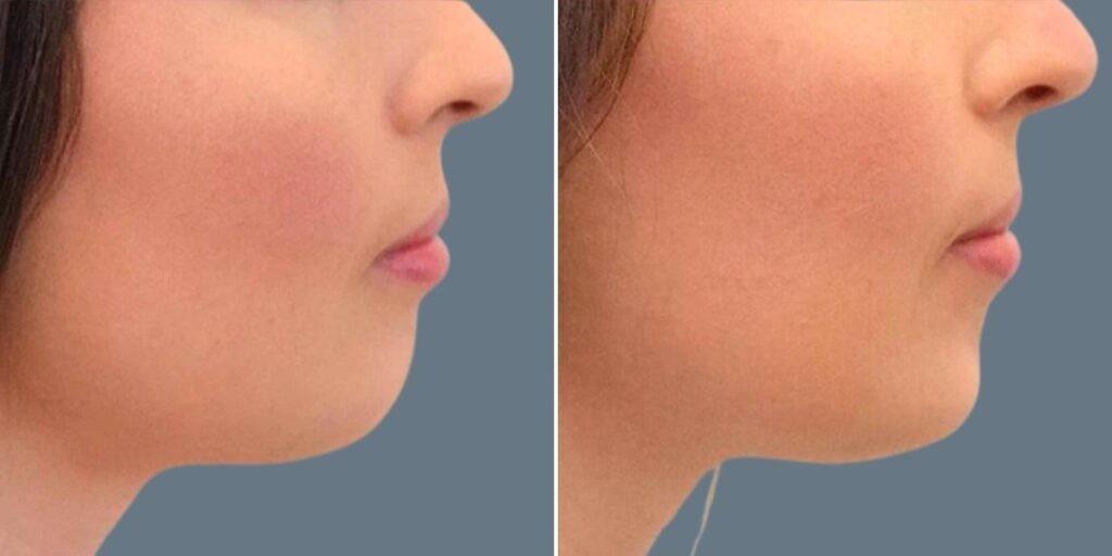 Face Chin Enhancement Female Pre2024 001 Before And After
