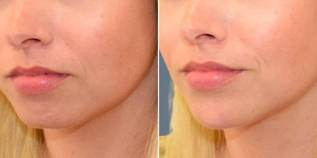 Face Chin Enhancement Female Pre2024 002 Before And After