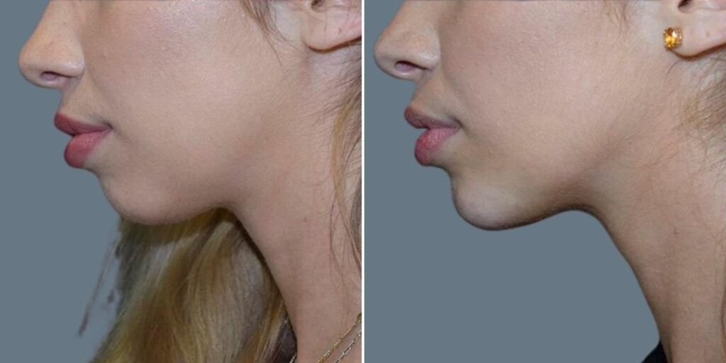 Face Chin Enhancement Female Pre2024 003 Before And After