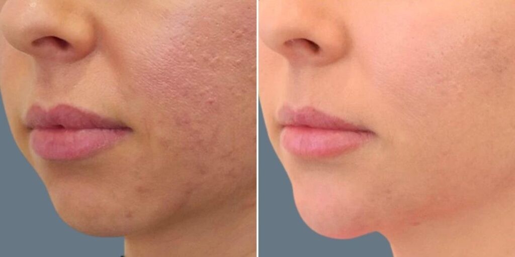 Face Chin Enhancement Female Pre2024 005 Before And After