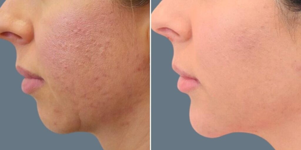 Face Chin Enhancement Female Pre2024 006 Before And After