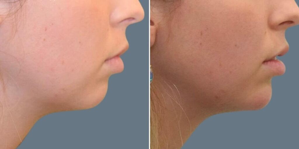 Face Chin Enhancement Female Pre2024 007 Before And After