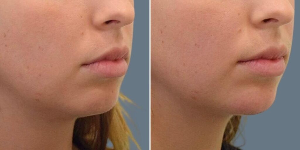 Face Chin Enhancement Female Pre2024 008 Before And After
