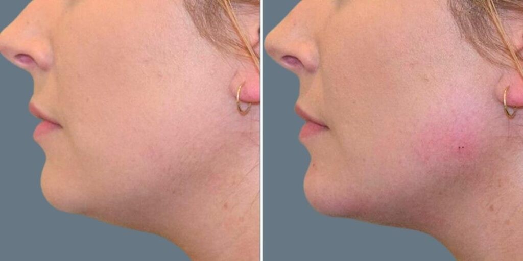 Face Chin Enhancement Female Pre2024 010 Before And After