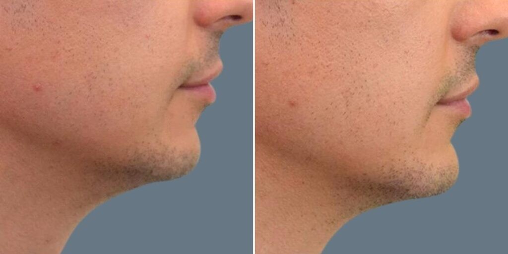 Face Chin Enhancement Male Pre2024 004 Before And After