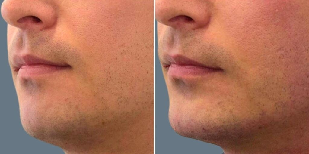 Face Chin Enhancement Male Pre2024 009 Before And After
