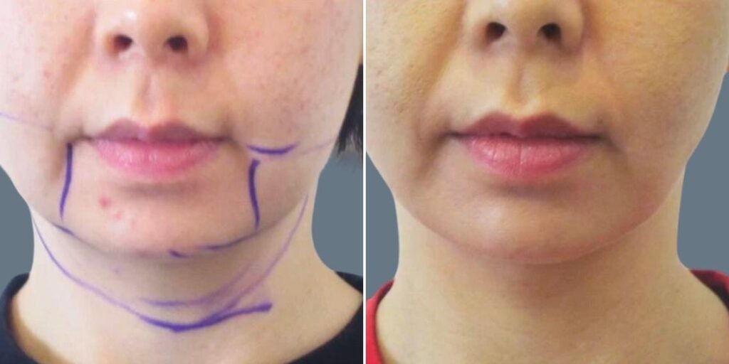 Face Chubby Cheeks Female Pre2024 001 Before And After