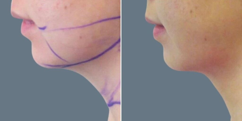 Face Chubby Cheeks Female Pre2024 002 Before And After