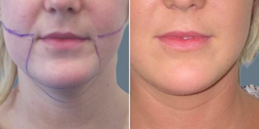 Face Chubby Cheeks Female Pre2024 003 Before And After