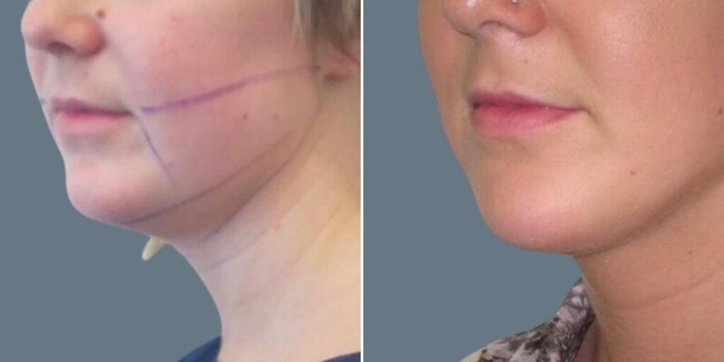 Face Chubby Cheeks Female Pre2024 004 Before And After