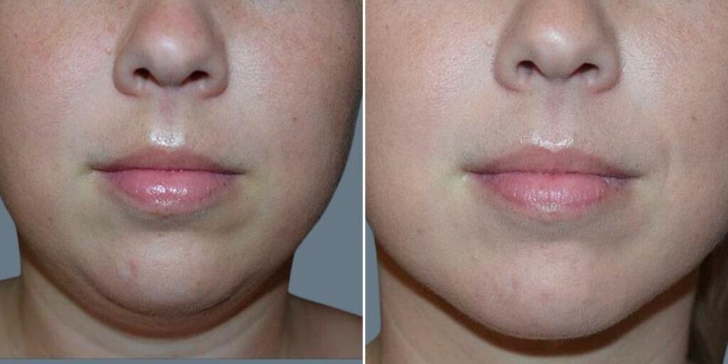 Face Chubby Cheeks Female Pre2024 005 Before And After