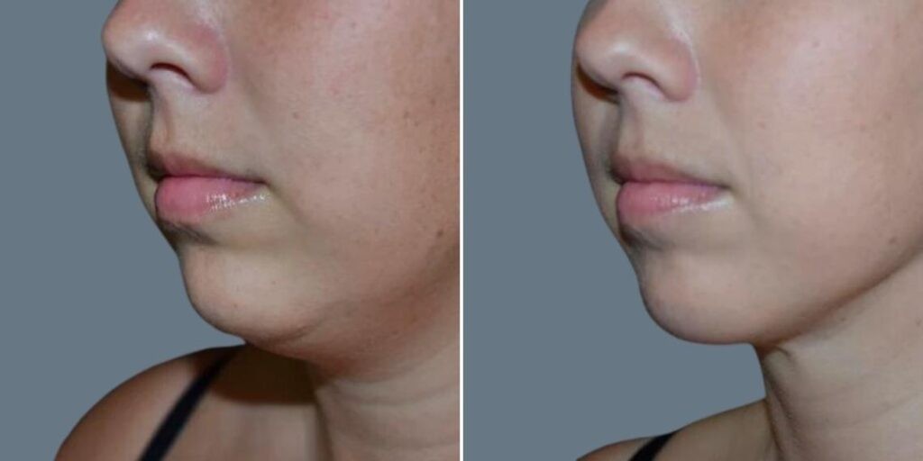 Face Chubby Cheeks Female Pre2024 006 Before And After