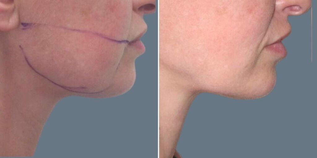 Face Chubby Cheeks Female Pre2024 007 Before And After