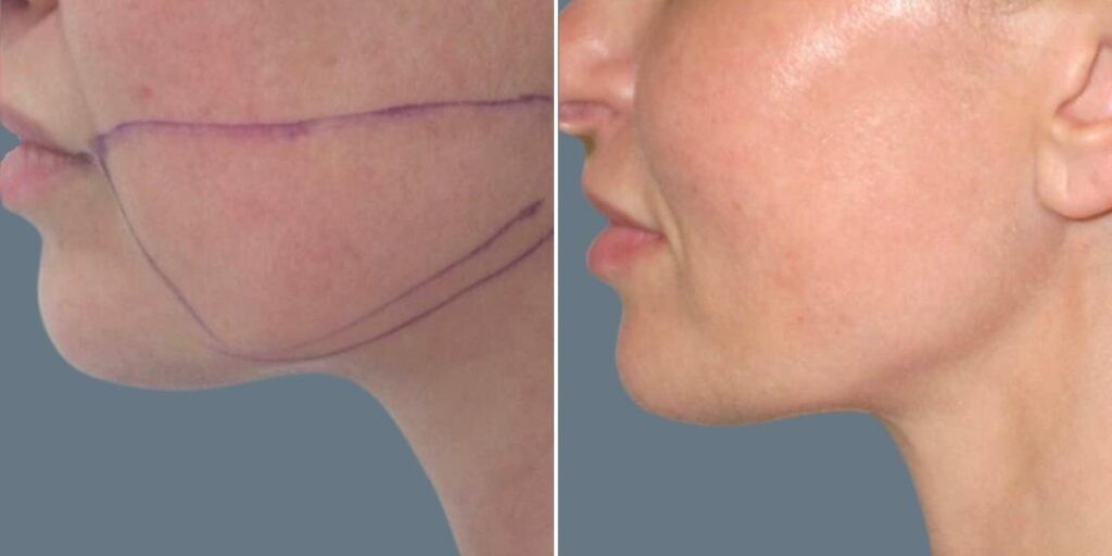 Face Chubby Cheeks Female Pre2024 008 Before And After