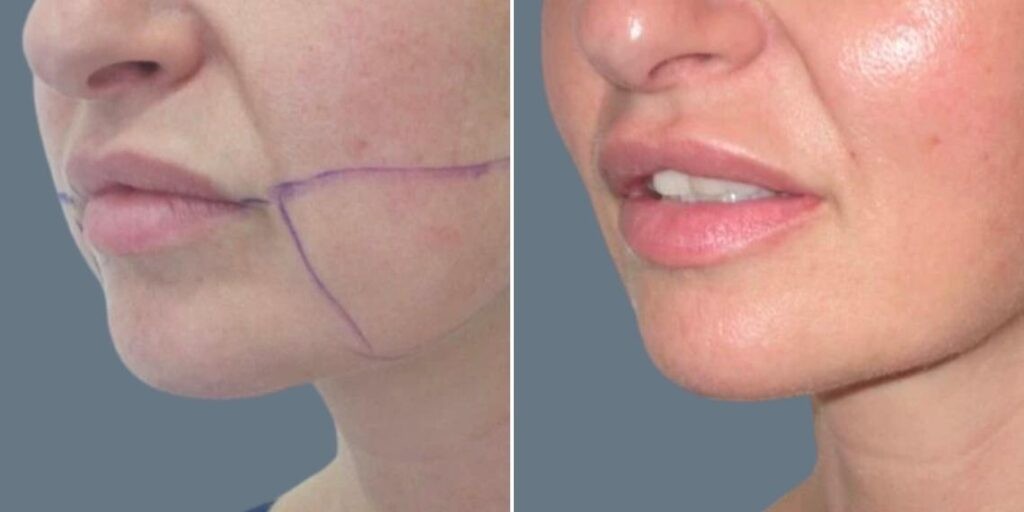 Face Chubby Cheeks Female Pre2024 009 Before And After