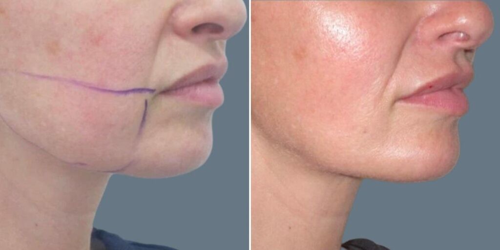 Face Chubby Cheeks Female Pre2024 010 Before And After