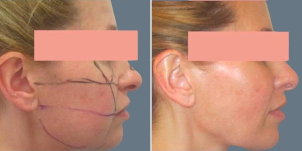 Face Chubby Cheeks Female Pre2024 011 Before And After