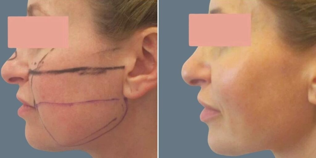 Face Chubby Cheeks Female Pre2024 012 Before And After